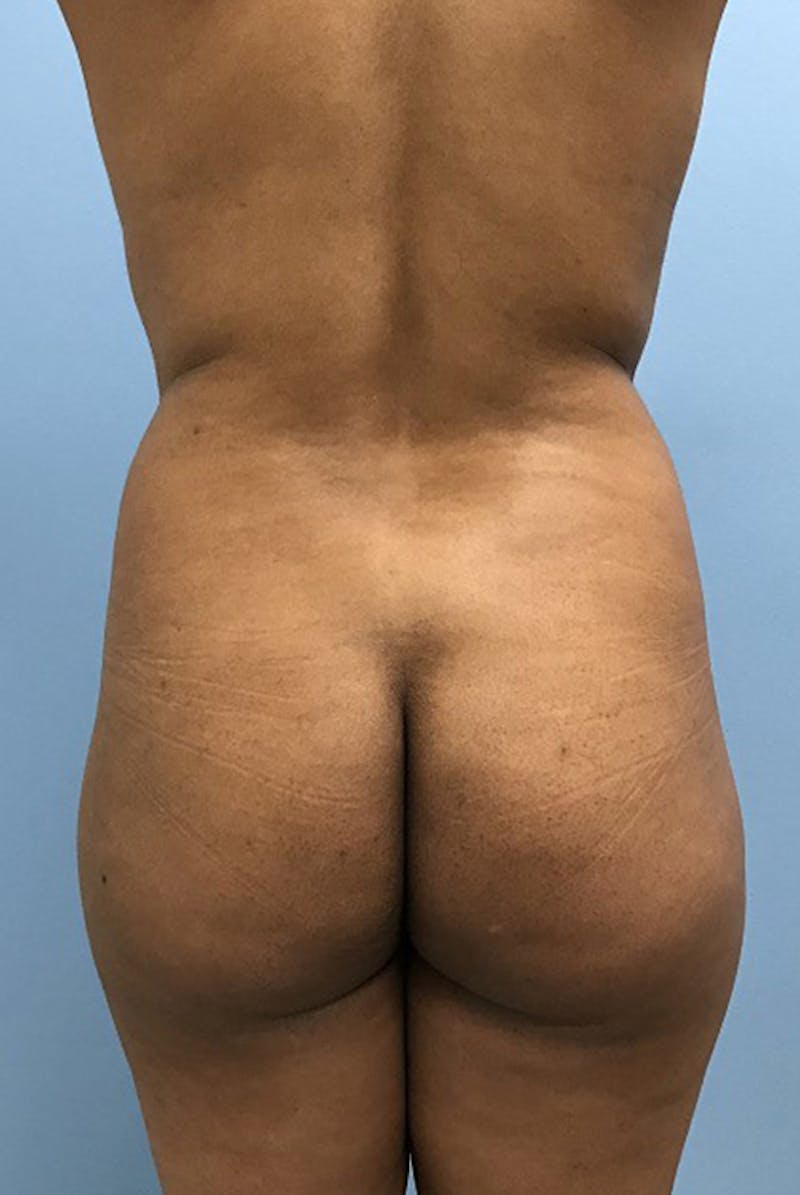 Liposuction Before & After Gallery - Patient 120905276 - Image 5