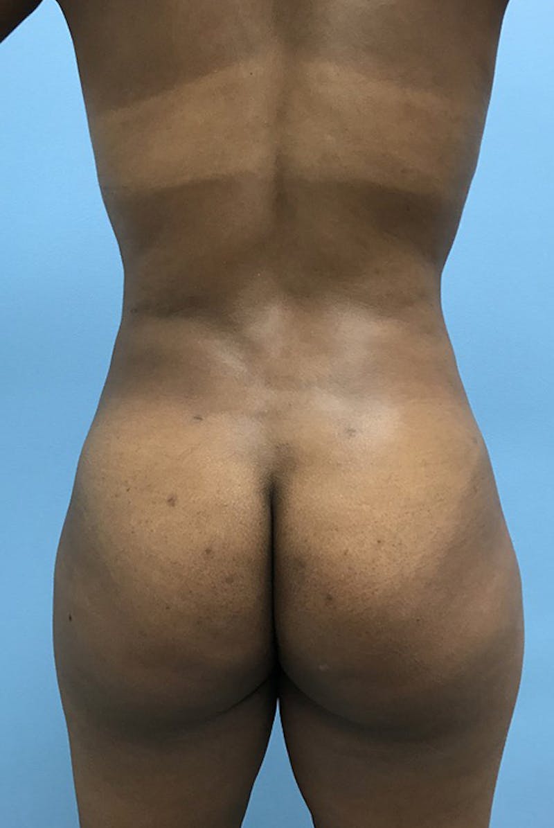 Liposuction Before & After Gallery - Patient 120905276 - Image 6
