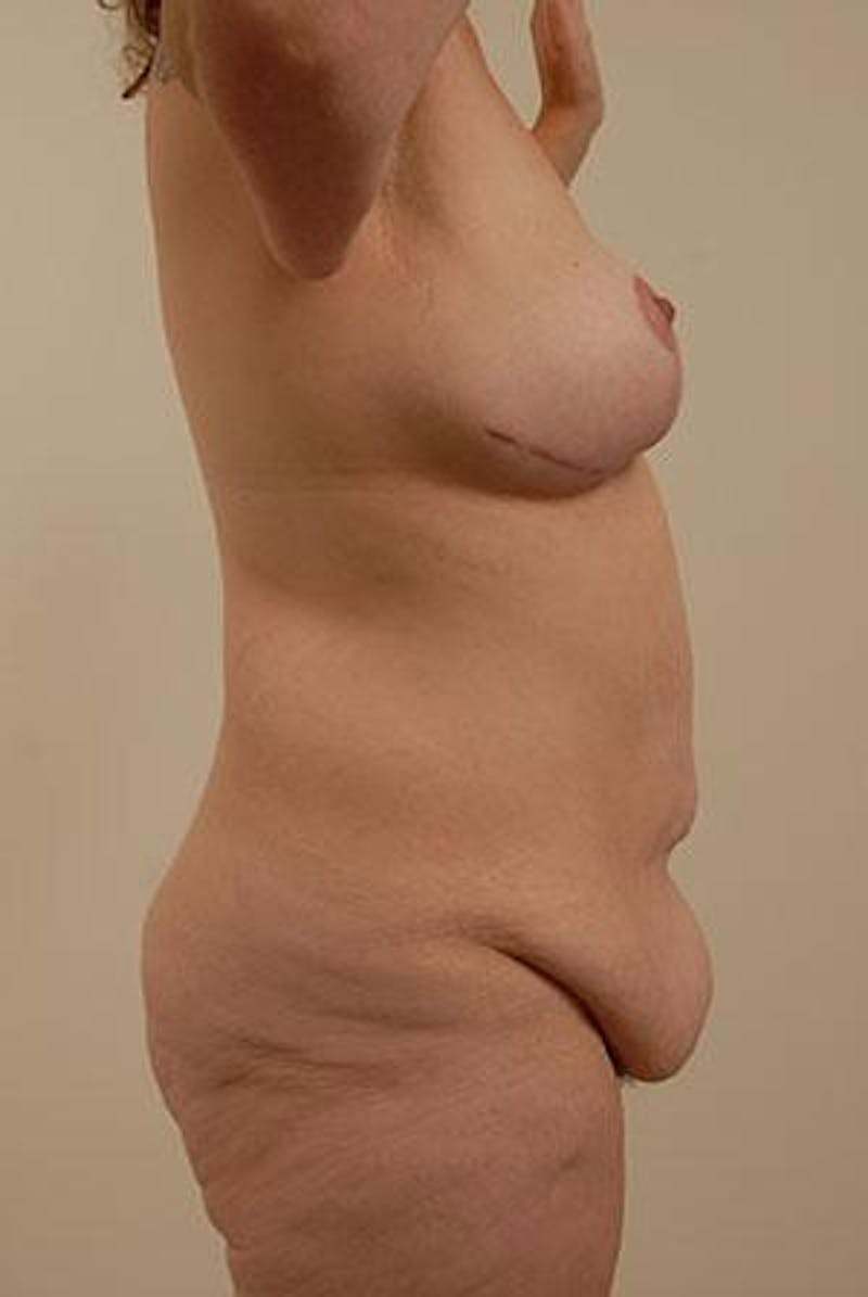 After Major Weight Loss Before & After Gallery - Patient 120905288 - Image 3