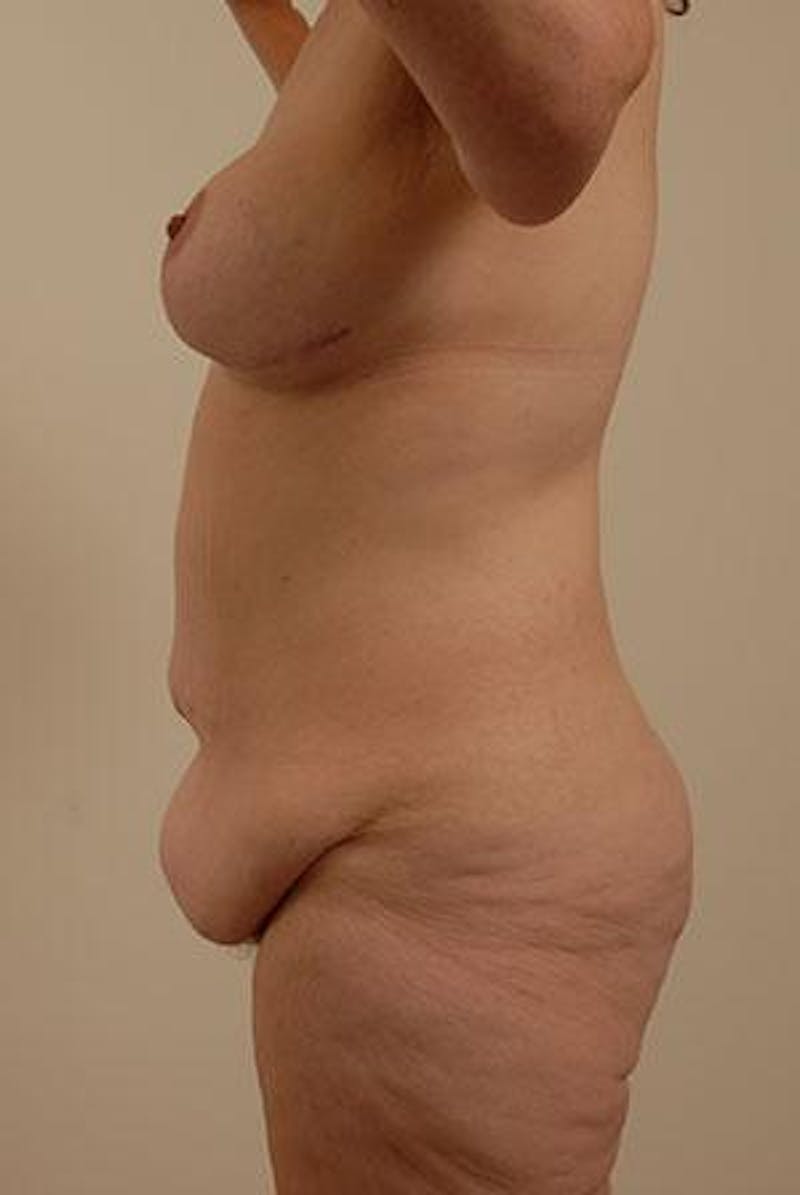 After Major Weight Loss Before & After Gallery - Patient 120905288 - Image 5