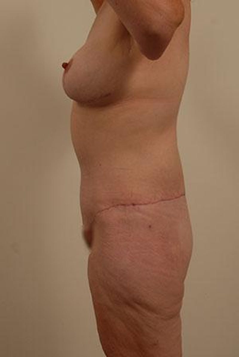 After Major Weight Loss Before & After Gallery - Patient 120905288 - Image 6
