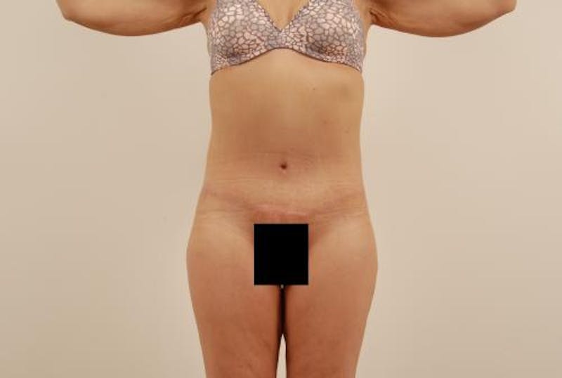 After Major Weight Loss Before & After Gallery - Patient 120905301 - Image 2