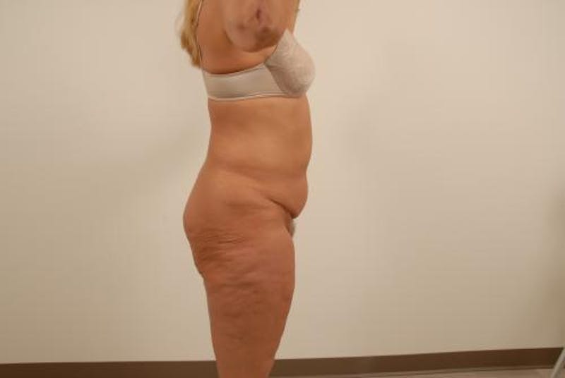 After Major Weight Loss Before & After Gallery - Patient 120905301 - Image 3