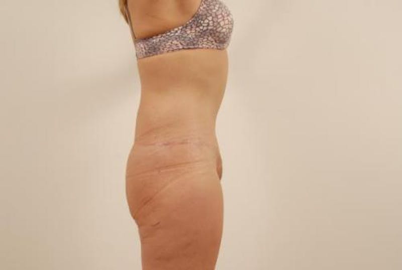 After Major Weight Loss Before & After Gallery - Patient 120905301 - Image 4