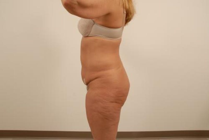 After Major Weight Loss Before & After Gallery - Patient 120905301 - Image 5