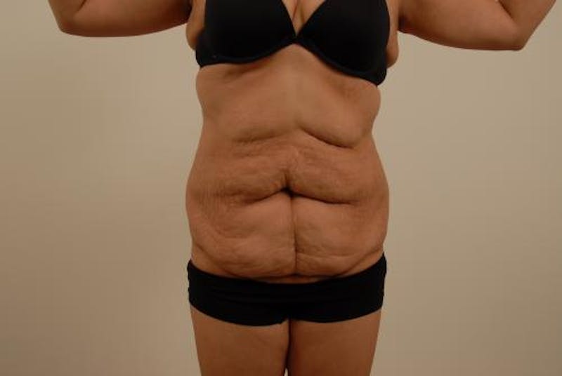 Tummy Tuck Before & After Gallery - Patient 120905302 - Image 1