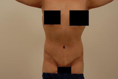 腹部整形手术前后画廊-病人120905302 -图2