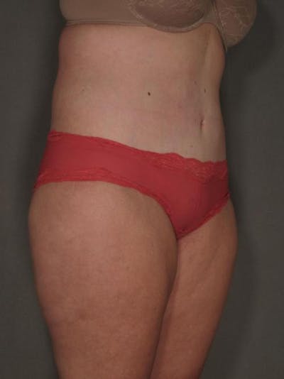 After Major Weight Loss Before & After Gallery - Patient 120905303 - Image 2