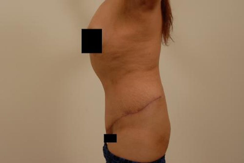 Tummy Tuck Before & After Gallery - Patient 120905302 - Image 6