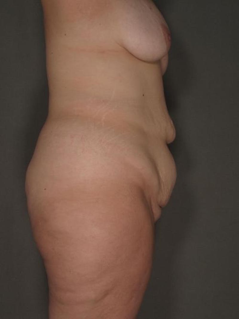 After Major Weight Loss Before & After Gallery - Patient 120905303 - Image 3