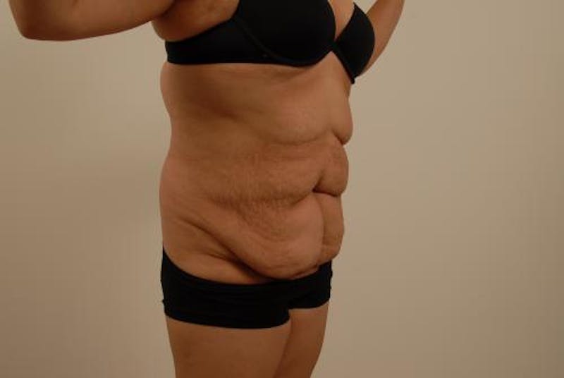 Tummy Tuck Before & After Gallery - Patient 120905302 - Image 7