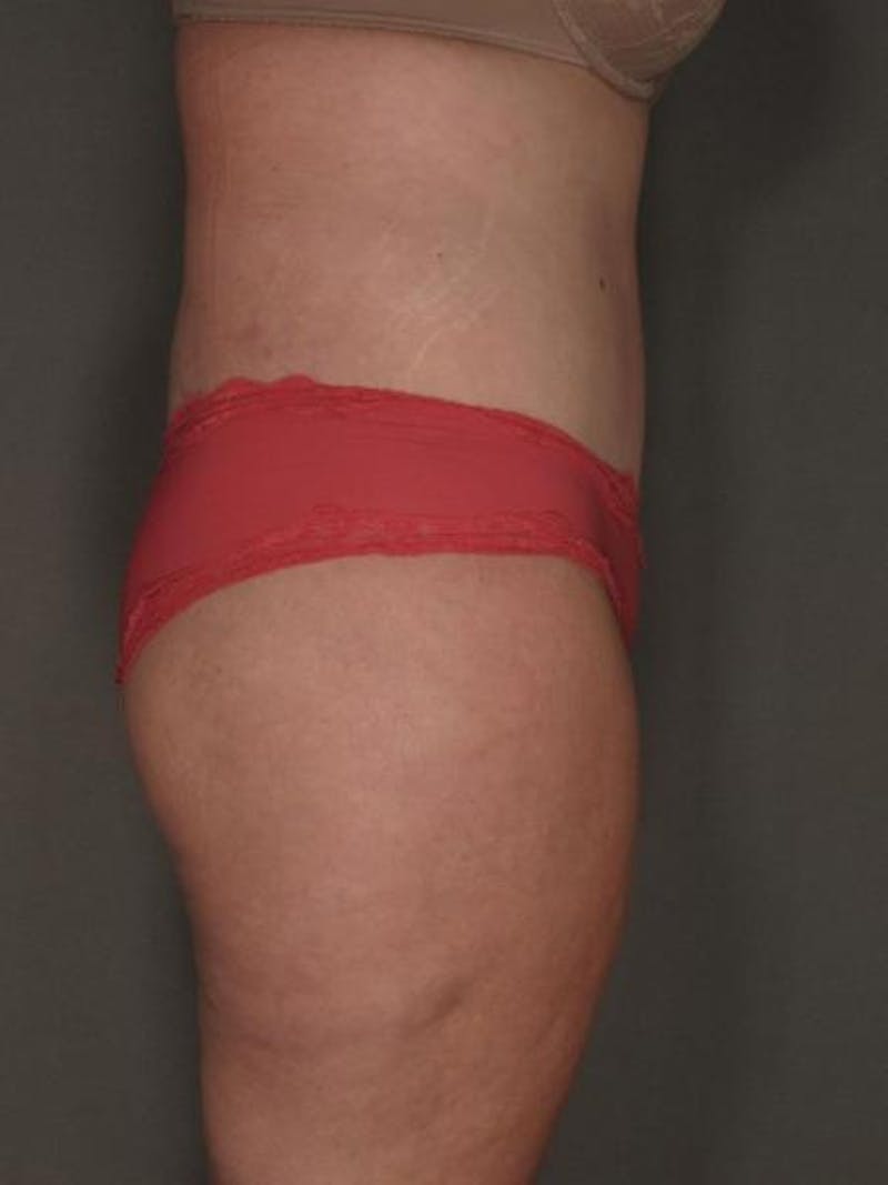 After Major Weight Loss Before & After Gallery - Patient 120905303 - Image 4