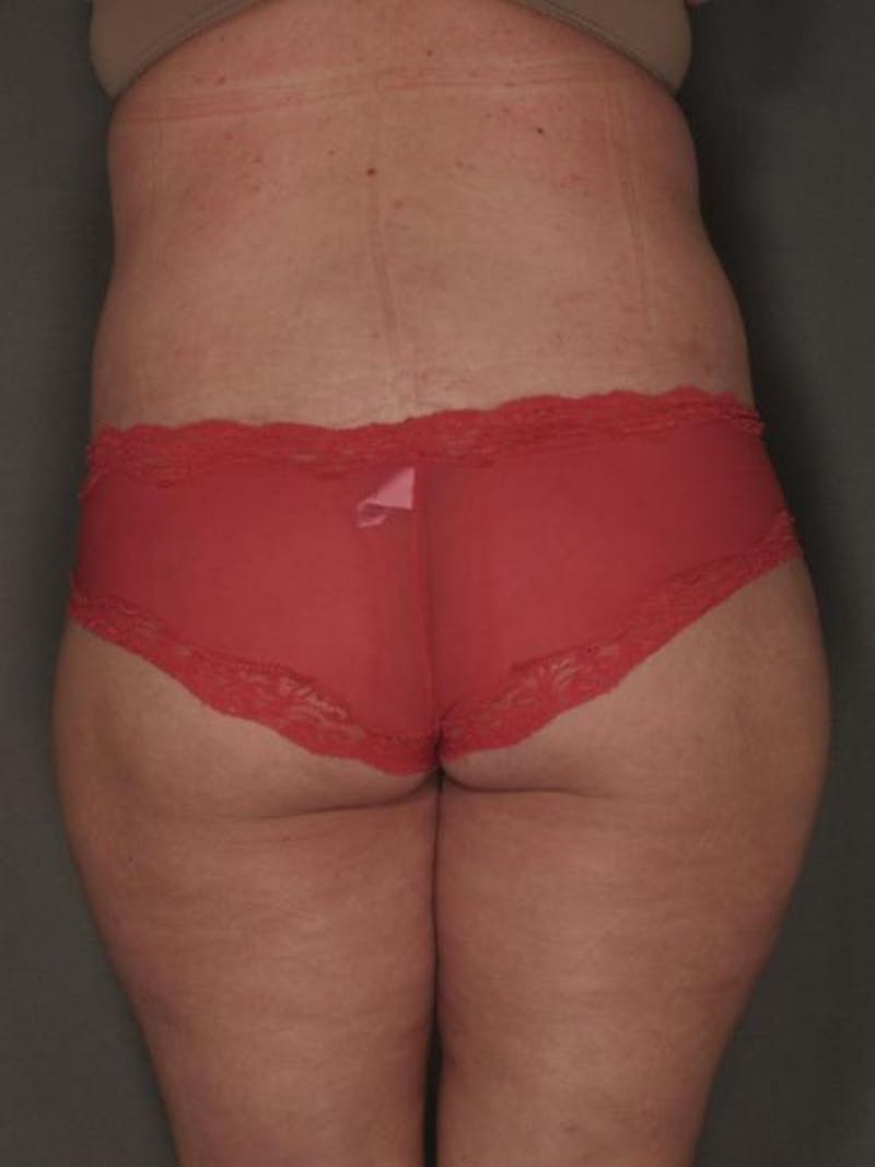 After Major Weight Loss Before & After Gallery - Patient 120905303 - Image 6