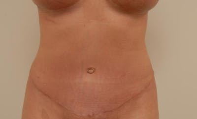腹部整形手术前后画廊-病人120905304 -图2