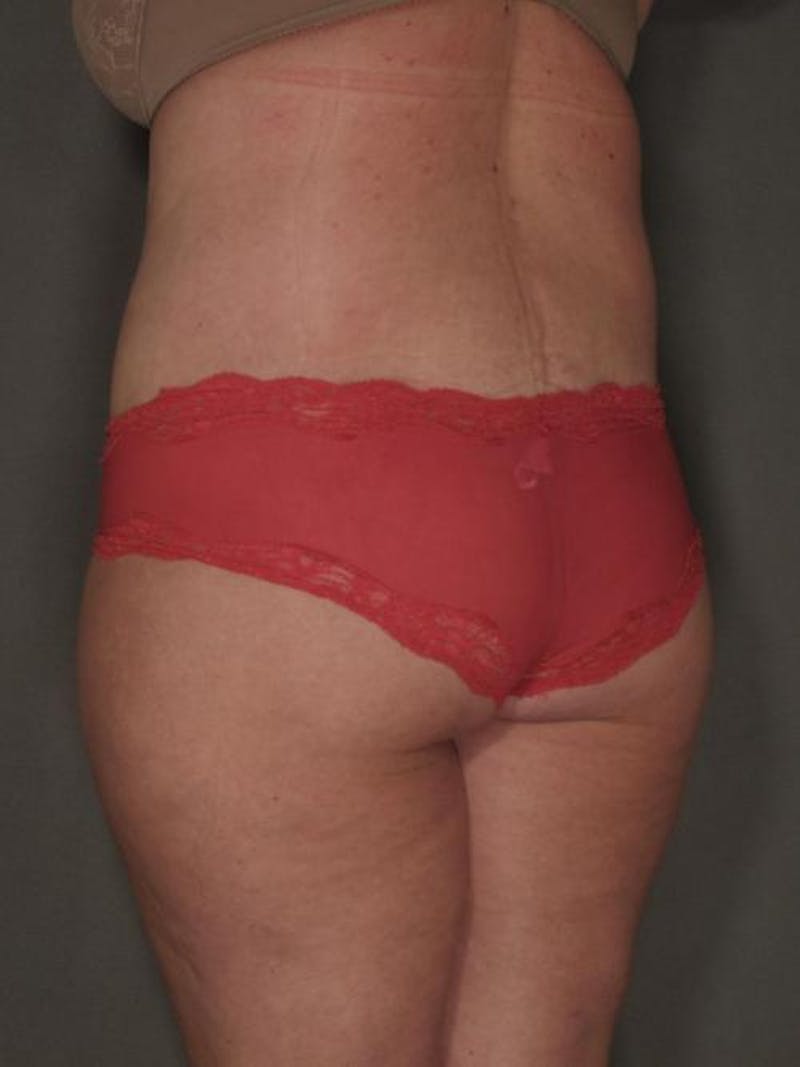 After Major Weight Loss Before & After Gallery - Patient 120905303 - Image 8
