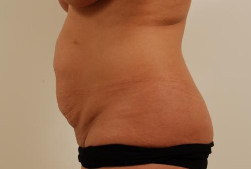 Tummy Tuck Gallery - Patient 120905304 - Image 3