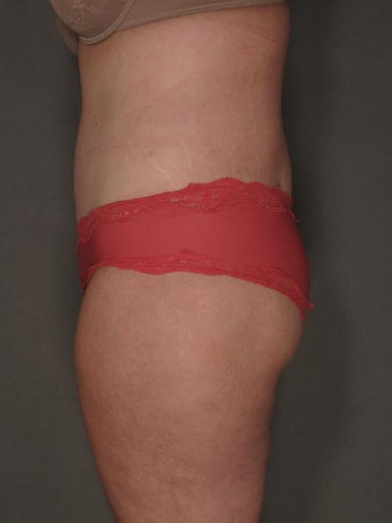 After Major Weight Loss Before & After Gallery - Patient 120905303 - Image 10