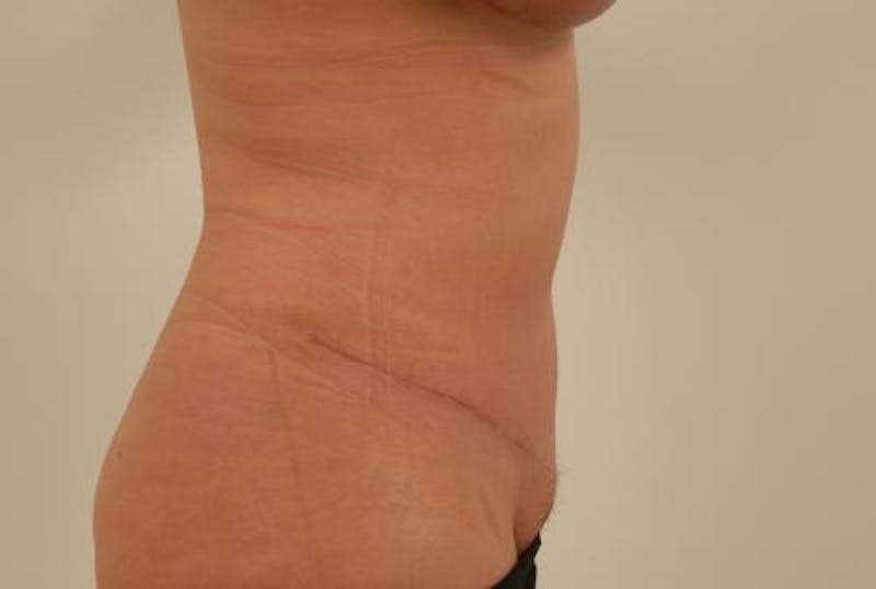 Tummy Tuck Before & After Gallery - Patient 120905304 - Image 6