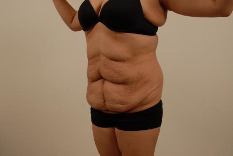 After Major Weight Loss Before & After Gallery - Patient 120905305 - Image 3