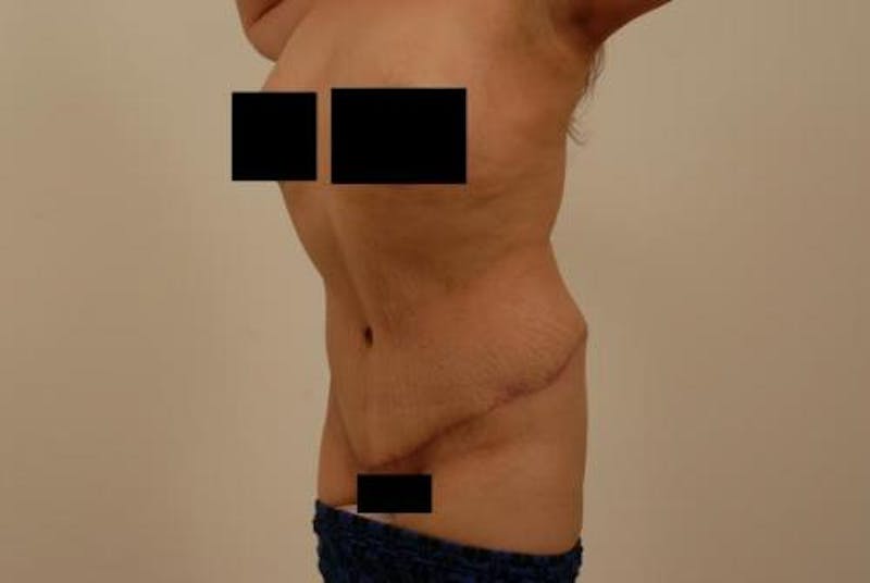 After Major Weight Loss Before & After Gallery - Patient 120905305 - Image 4