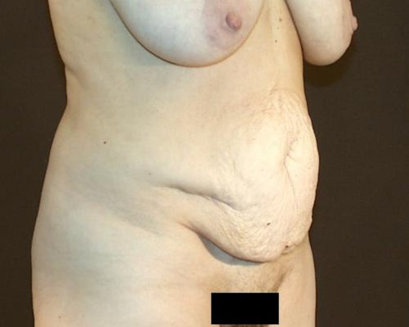 Tummy Tuck Before & After Gallery - Patient 120905308 - Image 3