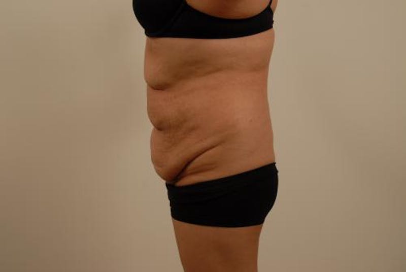 After Major Weight Loss Before & After Gallery - Patient 120905305 - Image 5