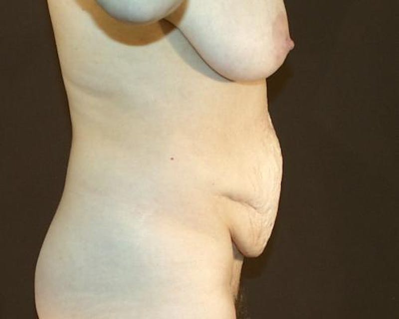 Tummy Tuck Before & After Gallery - Patient 120905308 - Image 5