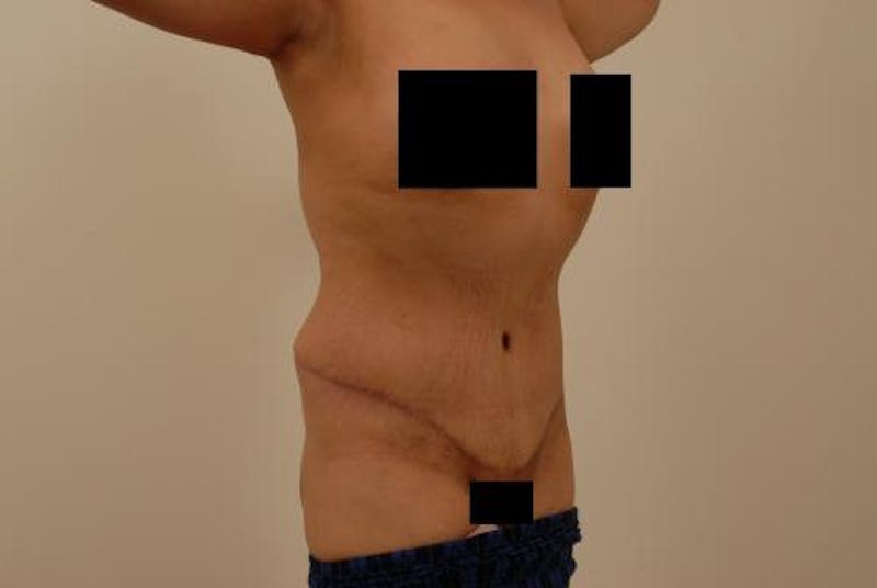 After Major Weight Loss Before & After Gallery - Patient 120905305 - Image 8