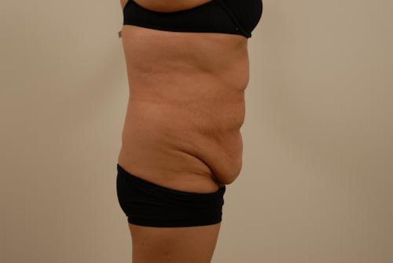 After Major Weight Loss Before & After Gallery - Patient 120905305 - Image 9