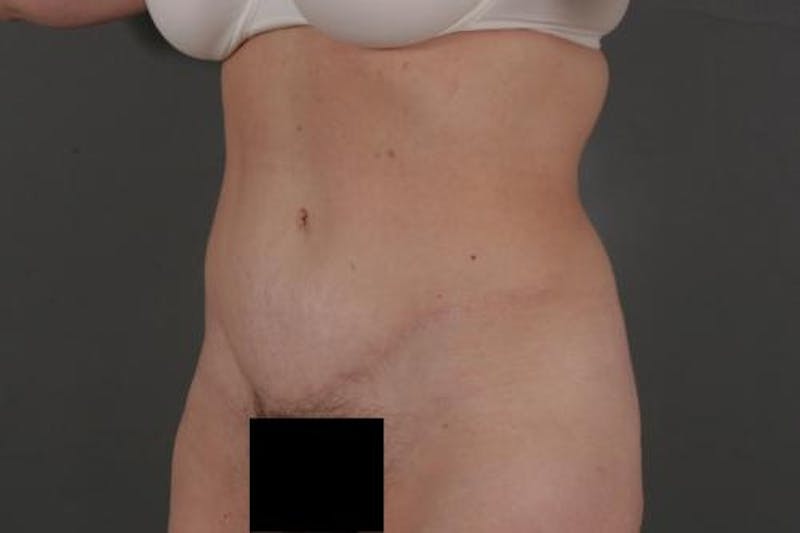 Tummy Tuck Before & After Gallery - Patient 120905308 - Image 8