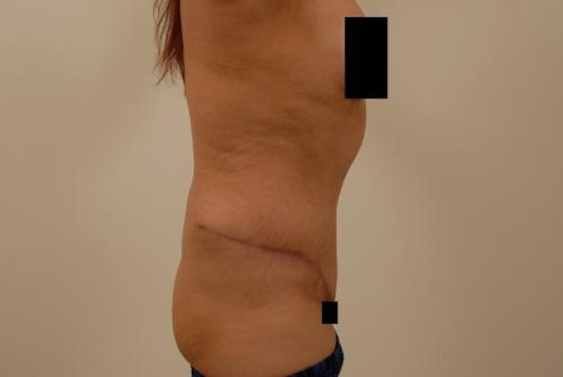 After Major Weight Loss Before & After Gallery - Patient 120905305 - Image 10