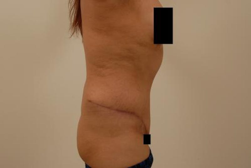 After Major Weight Loss Gallery - Patient 120905305 - Image 10