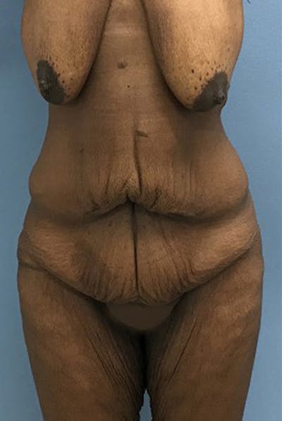 After Major Weight Loss Before & After Gallery - Patient 120905310 - Image 1