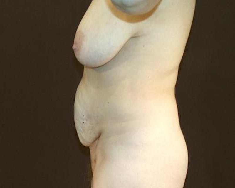 Tummy Tuck Before & After Gallery - Patient 120905308 - Image 10
