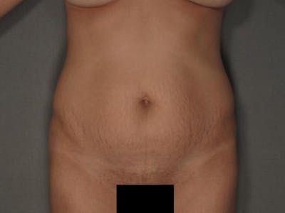 腹部整形手术前后画廊-病人120905311 -图片1