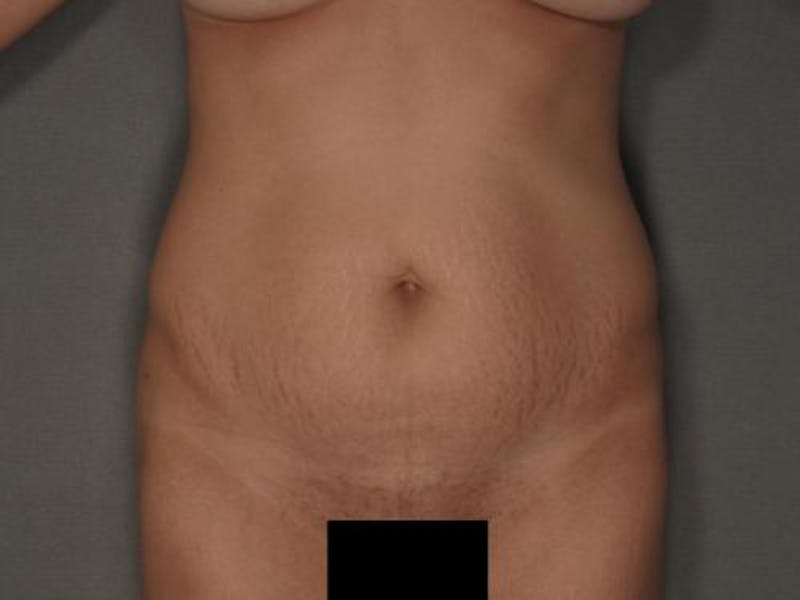 Tummy Tuck Before & After Gallery - Patient 120905311 - Image 1