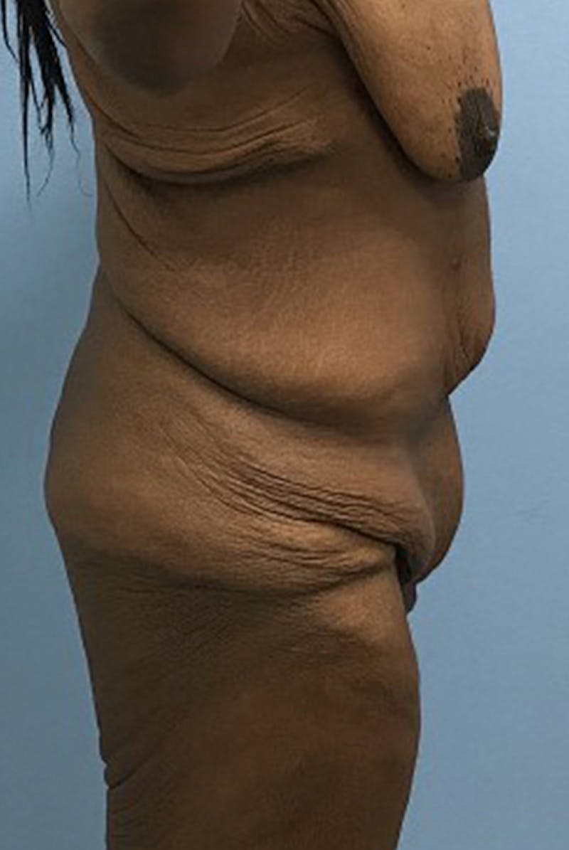 After Major Weight Loss Before & After Gallery - Patient 120905310 - Image 3