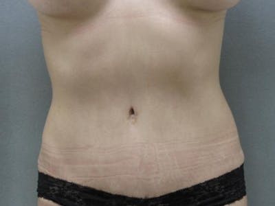 Tummy Tuck Before & After Gallery - Patient 120905311 - Image 2