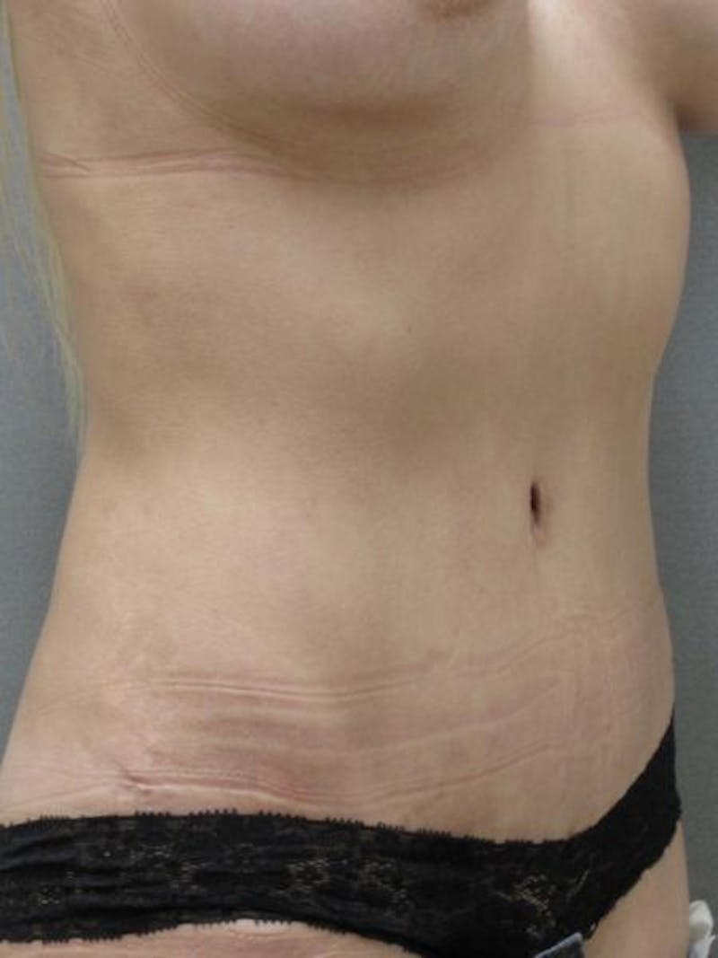Tummy Tuck Before & After Gallery - Patient 120905311 - Image 4
