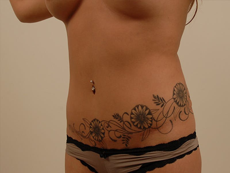 Tummy Tuck Before & After Gallery - Patient 120905318 - Image 4