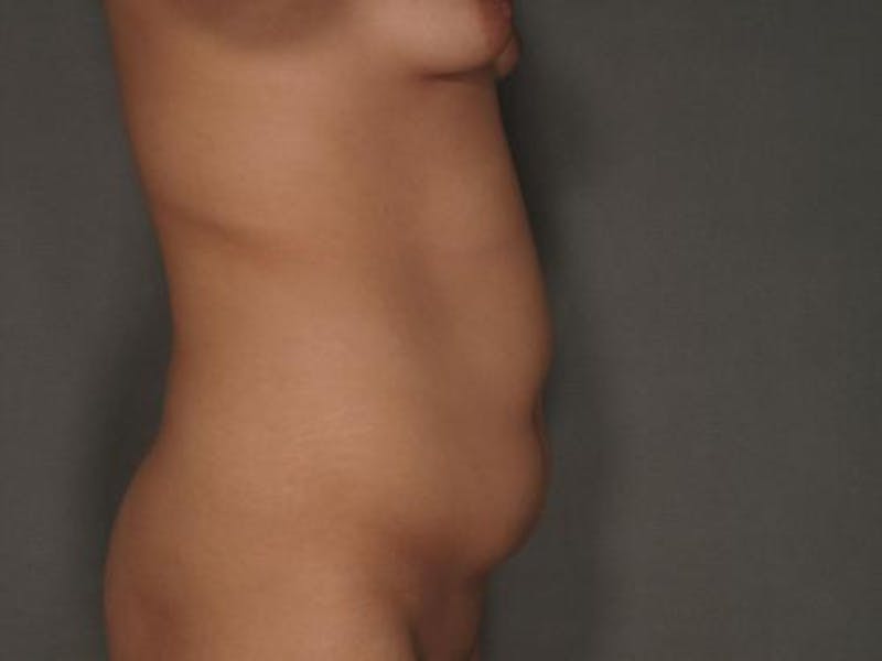Tummy Tuck Before & After Gallery - Patient 120905318 - Image 7