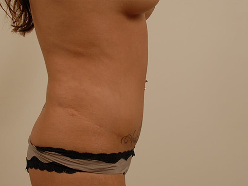 Tummy Tuck Before & After Gallery - Patient 120905318 - Image 6