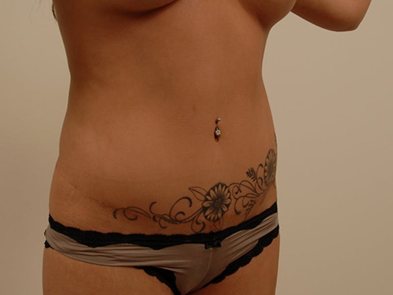 Tummy Tuck Before & After Gallery - Patient 120905318 - Image 10