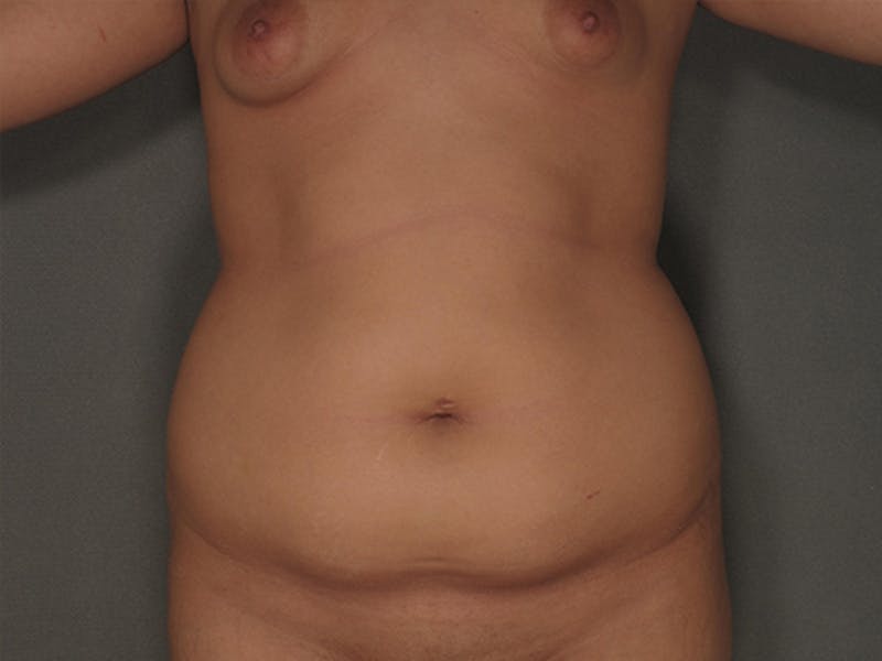 Tummy Tuck Before & After Gallery - Patient 120905318 - Image 1