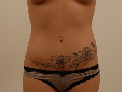 Tummy Tuck Before & After Gallery - Patient 120905318 - Image 2