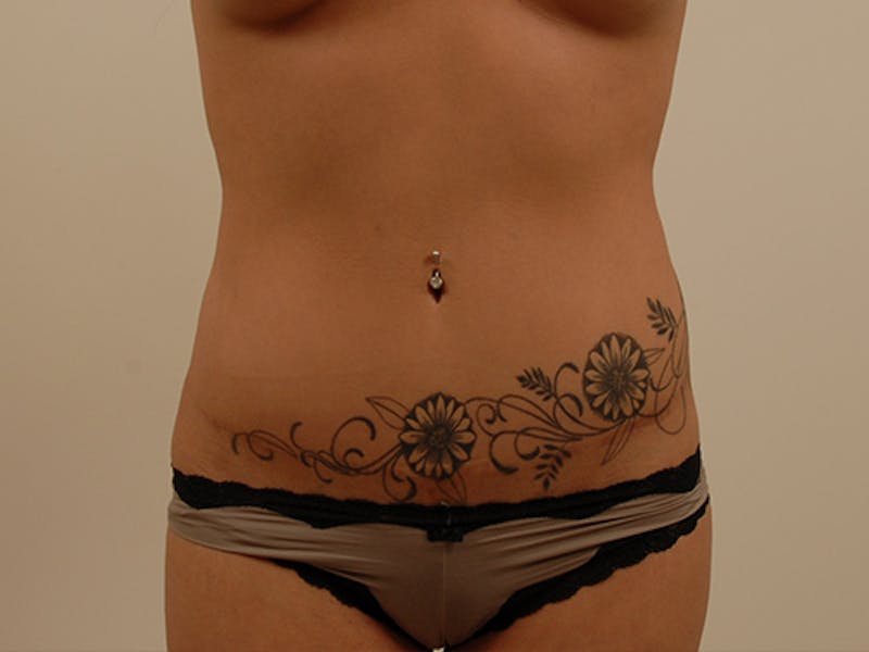 Tummy Tuck Before & After Gallery - Patient 120905318 - Image 2