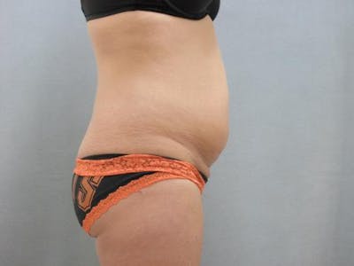 Tummy Tuck Before & After Gallery - Patient 120905340 - Image 1