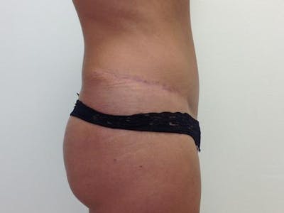腹部整形手术前后图库-患者120905340 -图2