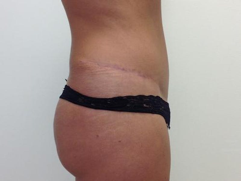 Tummy Tuck Before & After Gallery - Patient 120905340 - Image 2