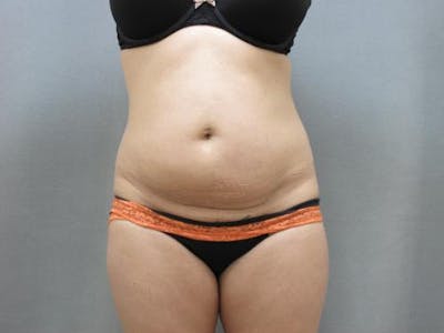 Tummy Tuck Before & After Gallery - Patient 120905340 - Image 1